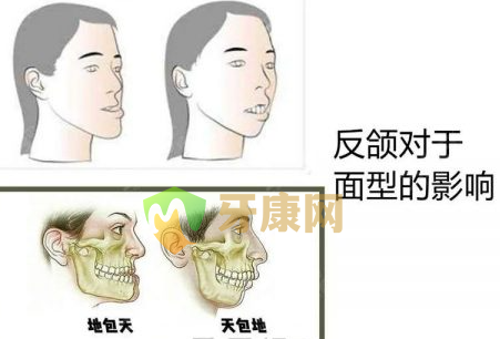 地包天牙齿图片
