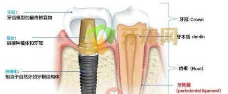 种植牙是什么