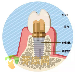 种植牙结构图解高清照片图片