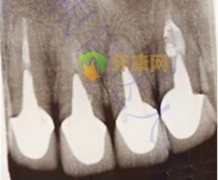 铸造桩