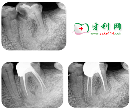 根管治疗病例