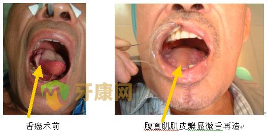 舌癌的早期症状