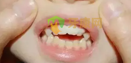 肌功能训练矫治器