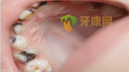 牙根发黑图片