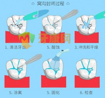 儿童牙齿窝沟封闭