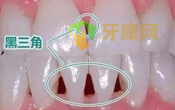牙齿“黑三角”高清图片