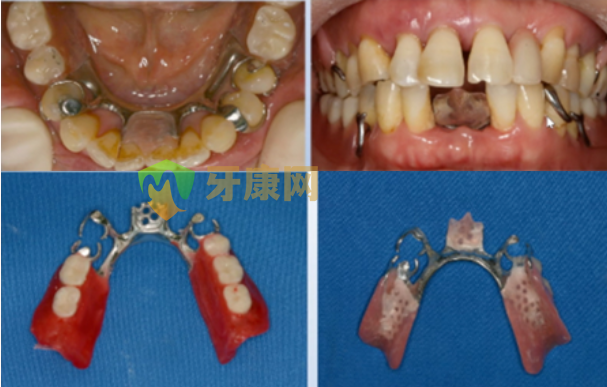 可摘局部义齿在欲拔牙位置预留金属网