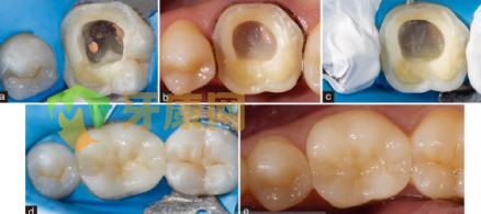 牙冠修复过程图解