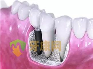 牙齿缺失不种植 易引发健康连锁反应