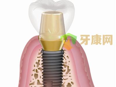 种植牙修复过程需要多长时间？