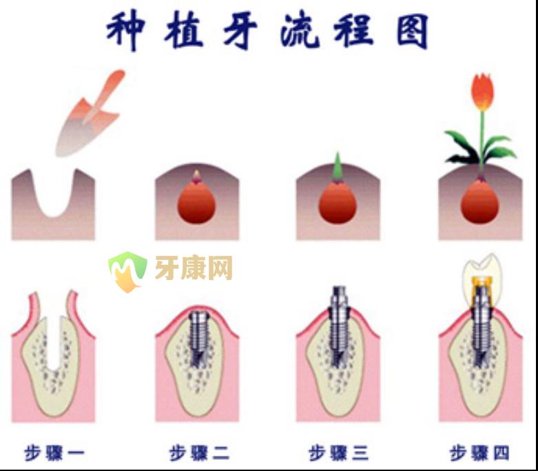 种植牙替代天然牙真可一劳永逸？