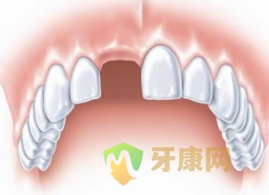 种植牙修复单颗牙齿缺失有哪些好处