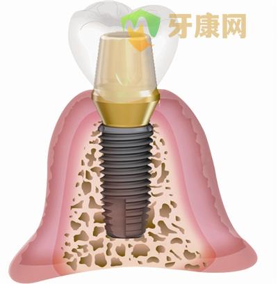 做种植牙前需要检查什么