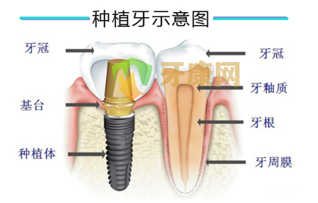 为什么缺失牙修复都选种植牙？