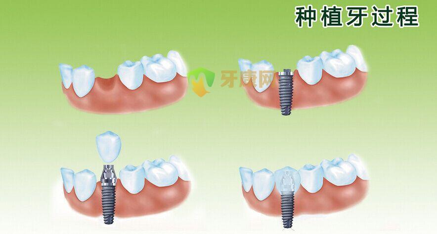 牙齿种植过程