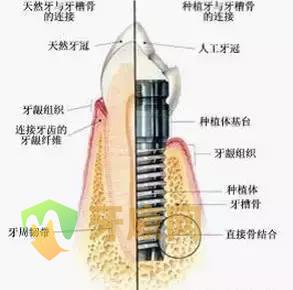 种植牙的优势和趋势