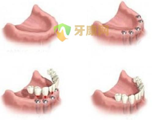 深圳全口缺失做种植牙需要多少钱？ 