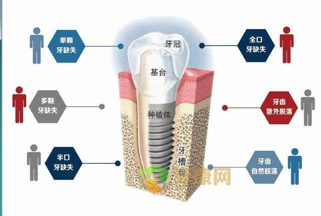 种植牙使用寿命