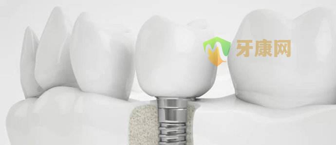 种植牙护理方法