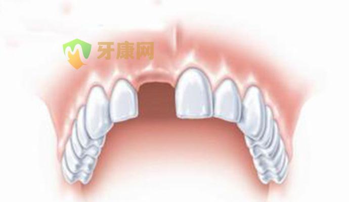 门牙缺失怎么办
