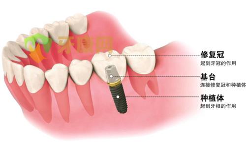 种植牙的要求