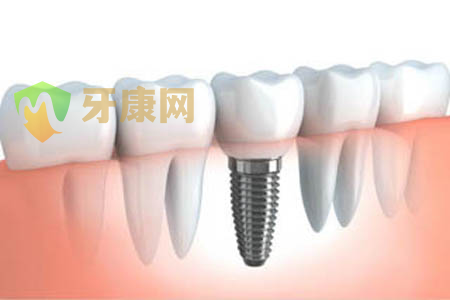牙齿矫正会影响种植牙吗