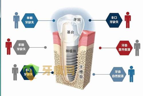 种植牙和固定桥修复区别