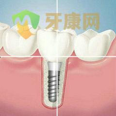牙齿缺失怎么办