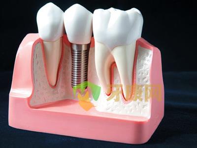 种植牙与假牙的区别