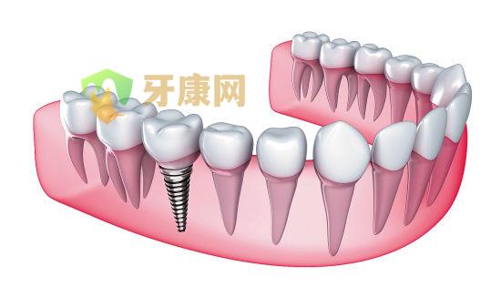 种植牙和真牙一样吗