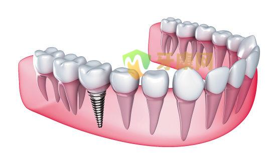 种植牙的常见问题有什么