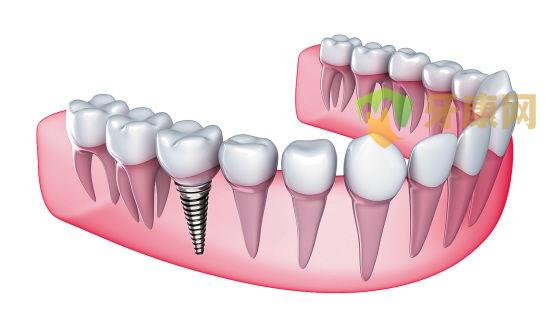 种植牙修复治疗方式