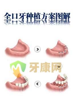 半口牙齿种植需要多少钱