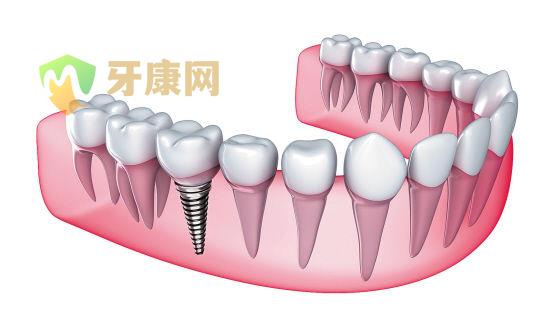 单颗牙种植后会出现松动么