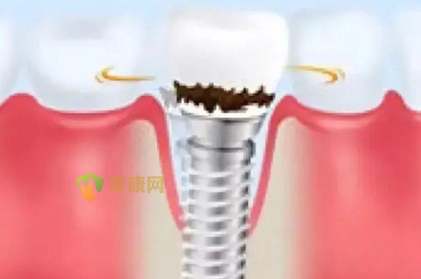 上部构造