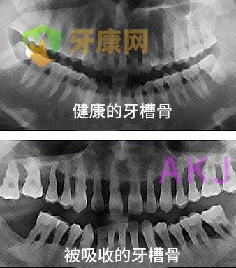 牙槽骨吸收严重