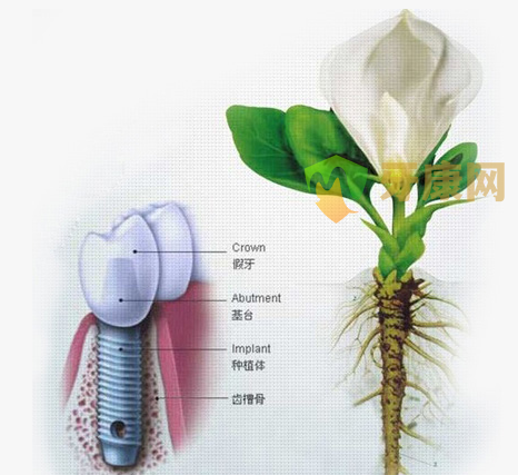 深圳牙健网种植牙