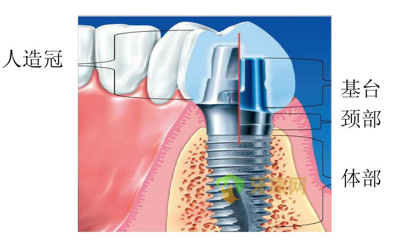 深圳牙健网口腔医院种植义齿一般多少钱？