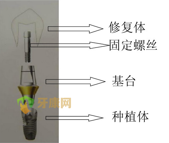 深圳牙健网口腔医院种植义齿