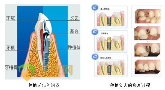 深圳牙健网种植义齿有哪些危害？