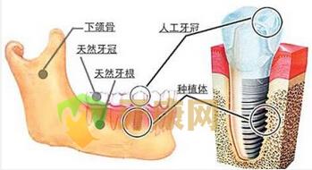  种植牙后可以吃东西吗？能啃骨头吗？