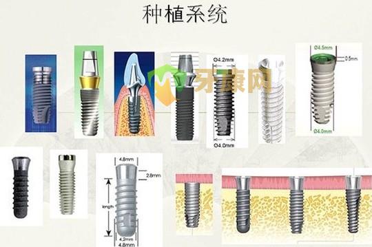 种植牙的费用是怎么算的？