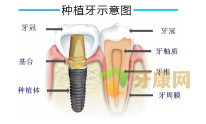 种植牙常见的几大误区