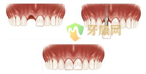 美国Bicon种植系统多少钱？