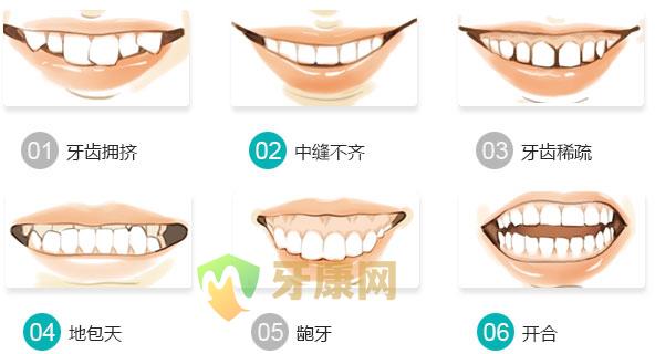 牙齿不齐的症状和表现有哪些？
