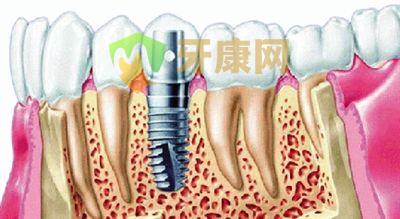 深圳种植牙