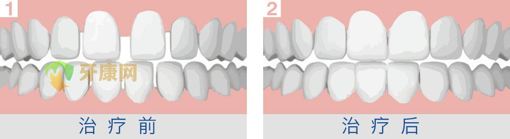矫正牙齿稀疏的方法有哪些
