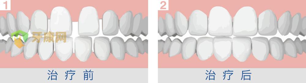 牙齿稀疏有危害吗