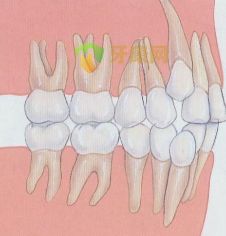 牙齿拥挤的原因