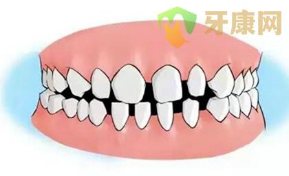 如何预防牙齿稀疏